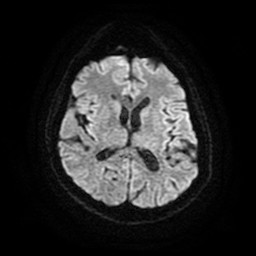 File:Acute superior cerebellar artery territory infarct (Radiopaedia 84104-99358 Axial DWI 48).jpg