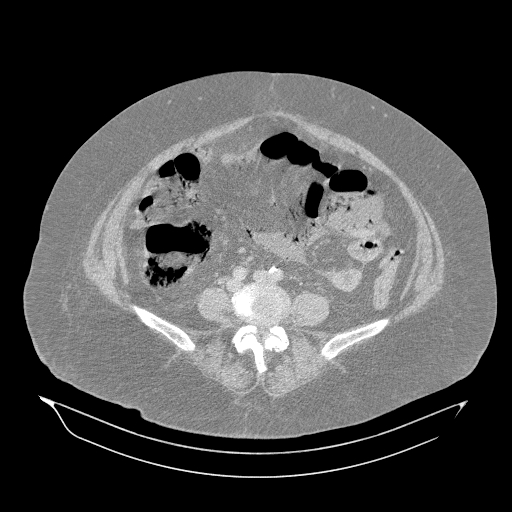 Acute superior mesenteric artery occlusion (Radiopaedia 51288-56960 Axial lung window 44).jpg