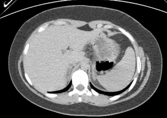 Acute unilateral nonhemorrhagic adrenal infarction (Radiopaedia 67560-76957 Axial renal excretory phase 14).jpg