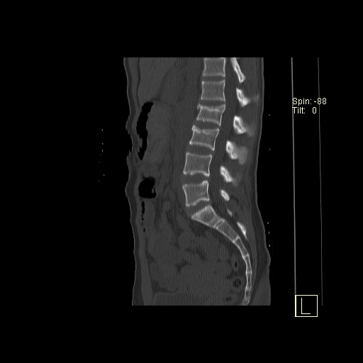 File:Acute vertebral compression fracture (Radiopaedia 63832-72559 Sagittal bone window 9).jpg