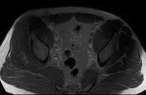 File:Adductor longus tear with retraction (Radiopaedia 56424-63103 Axial T2 fat sat 4).jpg