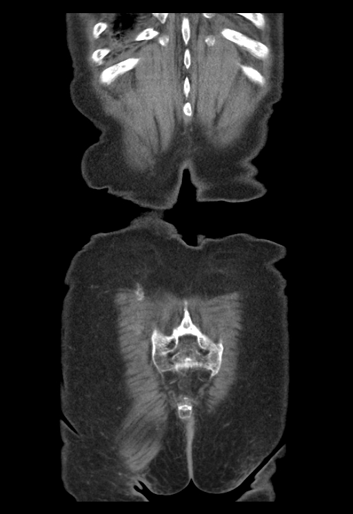 Adenocarcinoma of cecum (Radiopaedia 59222-66549 Coronal C+ portal venous phase 69).jpg