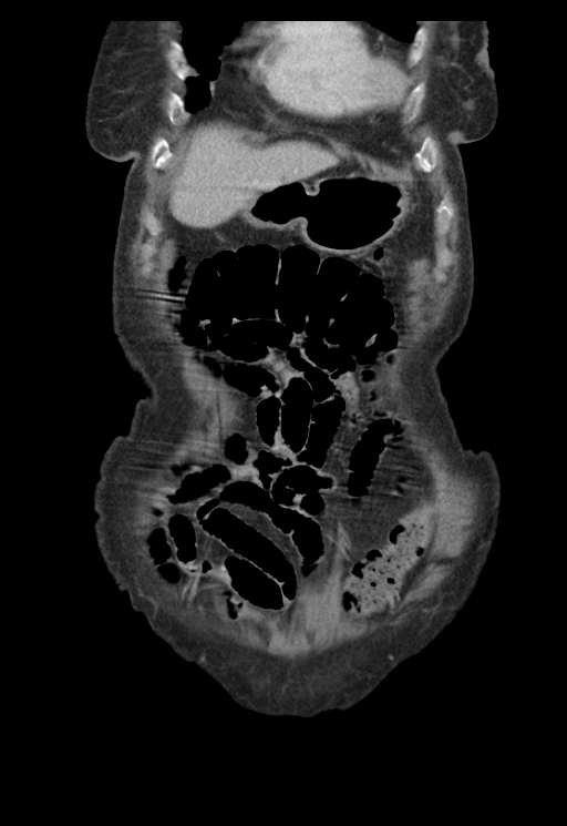 Adenocarcinoma of cecum (Radiopaedia 59222-66549 Coronal C+ portal venous phase 7).jpg