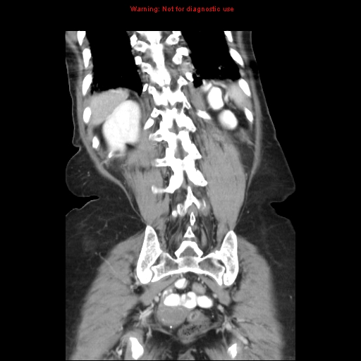 File:Adenocarcinoma of the colon (Radiopaedia 8191-9039 Coronal liver window 38).jpg