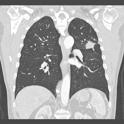 Adenocarcinoma of the lung (Radiopaedia 59871-67325 Coronal lung window 38).jpg
