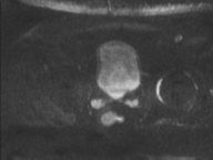 Adenocarcioma of rectum- T1 lesion (Radiopaedia 36921-38546 Axial DWI 44).png