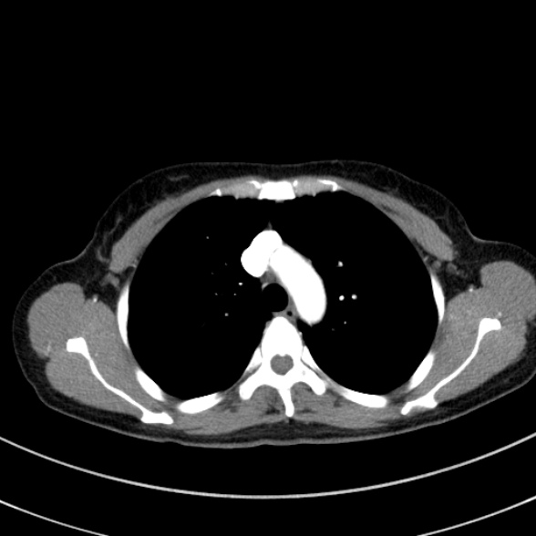 Adenocystic carcinoma of the trachea (Radiopaedia 47677-52525 Axial C+ arterial phase 41).jpg
