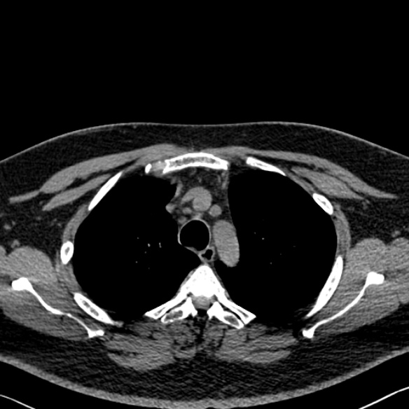 Adenoid cystic carcinoma of the trachea (Radiopaedia 49042-54137 Axial non-contrast 83).jpg