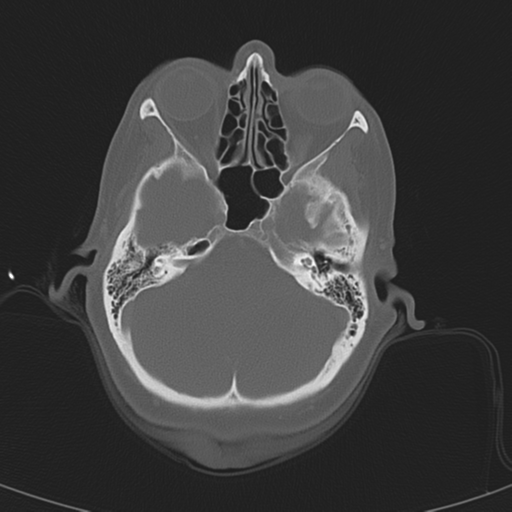 File:Adenoid cystic tumor of palate (Radiopaedia 46980-51518 Axial bone window 14).png