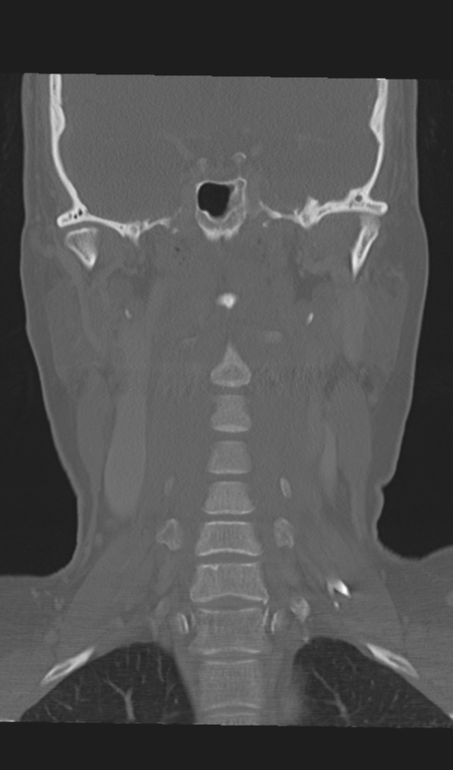 Adenoid cystic tumor of palate (Radiopaedia 46980-51518 Coronal bone window 37).png