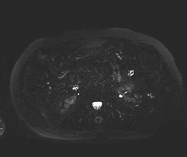 File:Adenomyomatosis of the gallbladder (Radiopaedia 50246-55587 Axial 10).png