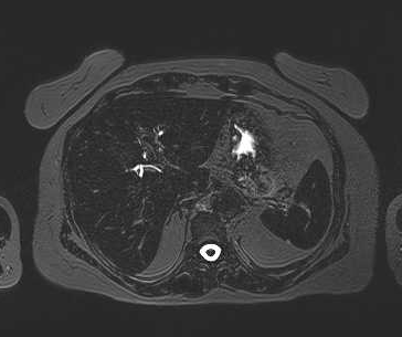 File:Adenomyomatosis of the gallbladder (Radiopaedia 50246-55587 Axial 90).png