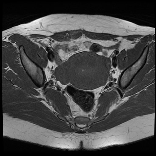 File:Adenomyosis-scar endometriosis (Radiopaedia 65863-75022 Axial T1 15).jpg