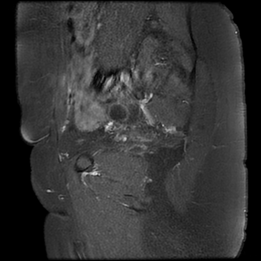 File:Adenomyosis-scar endometriosis (Radiopaedia 65863-75022 Sagittal T1 C+ fat sat 5).jpg