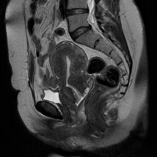 File:Adenomyosis-scar endometriosis (Radiopaedia 65863-75022 Sagittal T2 13).jpg