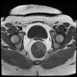 File:Adenomyosis within a didelphys uterus (Radiopaedia 70175-80215 Axial T1 31).jpg