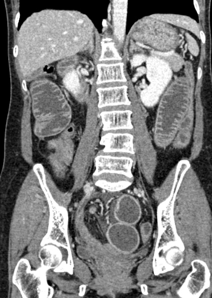 Adhesional small bowel obstruction (Radiopaedia 48397-53305 Coronal C+ portal venous phase 216).jpg