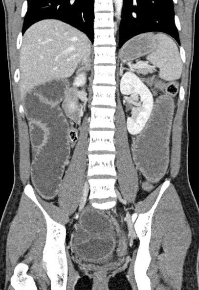 Adhesional small bowel obstruction (Radiopaedia 52107-57980 Coronal C+ portal venous phase 51).jpg