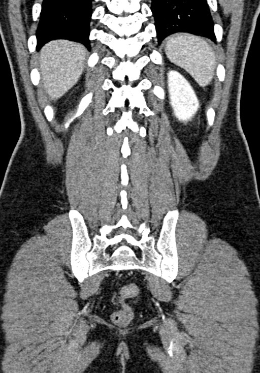 Adhesional small bowel obstruction (Radiopaedia 58900-66131 Coronal C+ portal venous phase 201).jpg