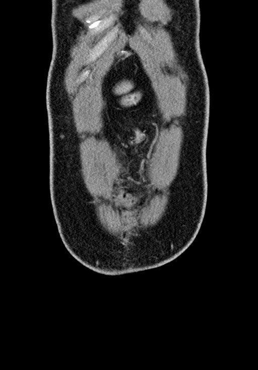 Adhesional small bowel obstruction (Radiopaedia 58900-66131 Coronal C+ portal venous phase 60).jpg