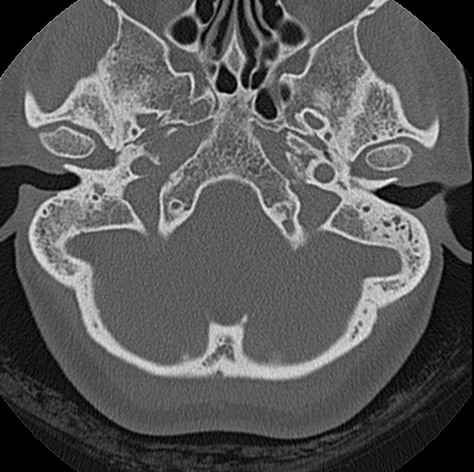 File:Adhesive chronic otitis media (Radiopaedia 14270-14148 Axial bone window 16).jpg