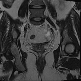 File:Adnexal multilocular cyst (O-RADS US 3- O-RADS MRI 3) (Radiopaedia 87426-103754 Coronal T2 20).jpg