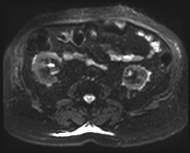 Adrenal cortical carcinoma (Radiopaedia 64017-72770 Axial DWI 32).jpg