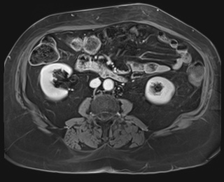 Adrenal cortical carcinoma (Radiopaedia 64017-72770 K 53).jpg