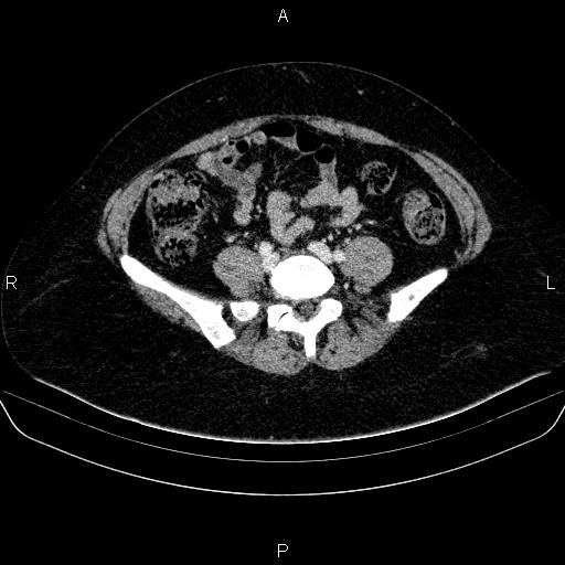 Adrenal cortical carcinoma (Radiopaedia 84882-100379 Axial C+ portal venous phase 64).jpg