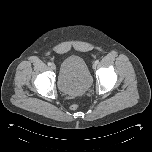Adrenal cyst (Radiopaedia 45625-49776 Axial C+ portal venous phase 90).png