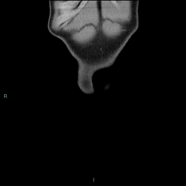 Adrenal cystic lymphangioma (Radiopaedia 83161-97534 Coronal C+ portal venous phase 5).jpg