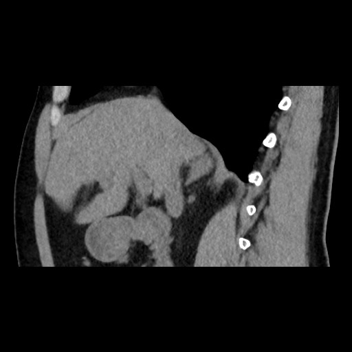 Adrenal gland trauma (Radiopaedia 81351-95079 Sagittal non-contrast 40).jpg