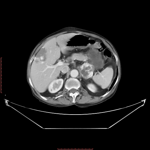 Adrenal hemangioma (Radiopaedia 68923-78668 Axial C+ portal venous phase 25).jpg
