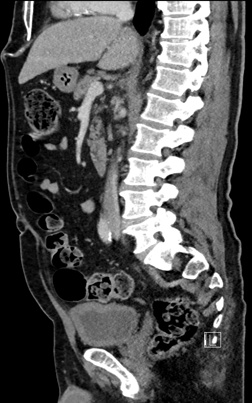 Adrenal lymphoma (Radiopaedia 73730-84529 Sagittal C+ portal venous phase 54).jpg