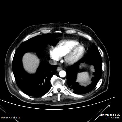 Adrenal metastasis (Radiopaedia 78425-91079 Axial C+ arterial phase 3).jpg