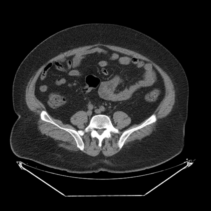 Adrenal myelolipoma (Radiopaedia 26278-26407 Axial non-contrast 48).jpg