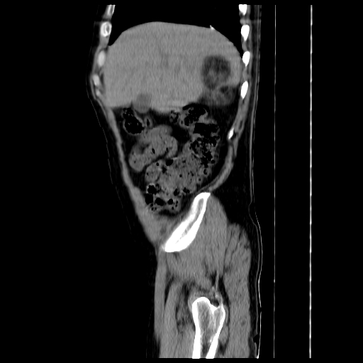 File:Adrenal myelolipoma (Radiopaedia 41843-44834 Sagittal non-contrast 1).jpg
