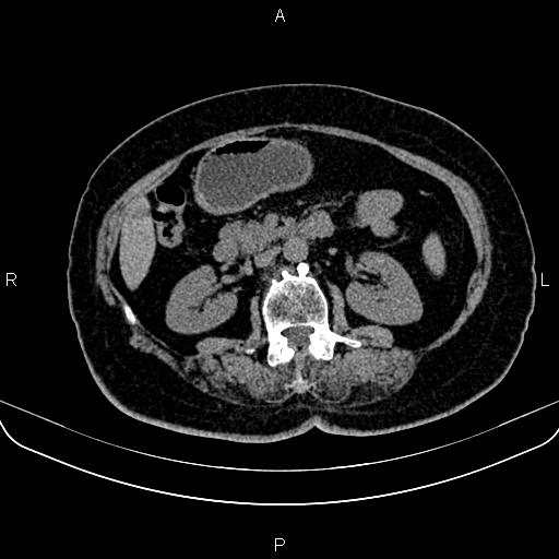 Adrenal myelolipoma (Radiopaedia 82742-96986 Axial non-contrast 69).jpg