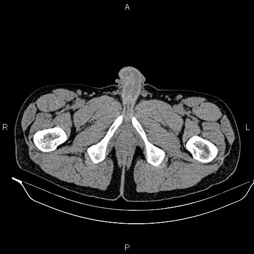 Adrenal myelolipoma (Radiopaedia 87794-104246 Axial non-contrast 115).jpg
