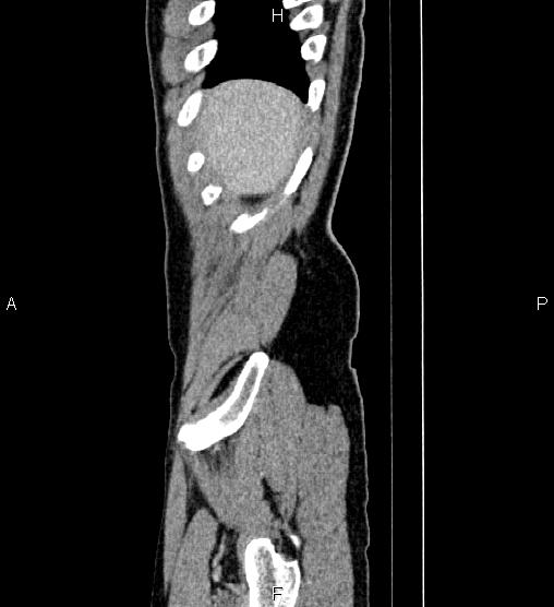 Adrenal myelolipoma (Radiopaedia 87794-104246 Sagittal renal cortical phase 5).jpg