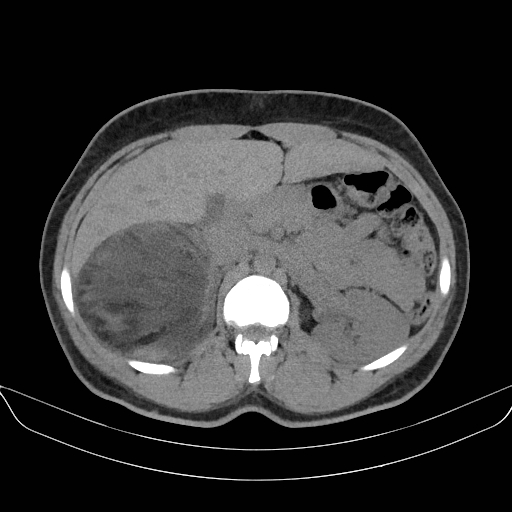 File:Adrenal myelolipoma - bilateral (Radiopaedia 74805-85810 Axial non-contrast 26).jpg