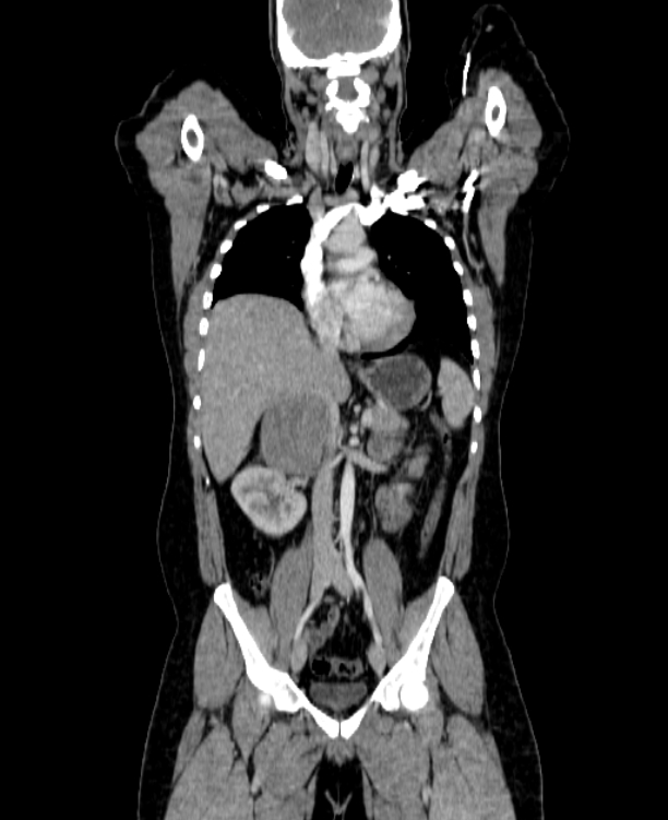Adrenocortical carcinoma (Radiopaedia 80134-93438 Coronal C+ portal venous phase 83).jpg