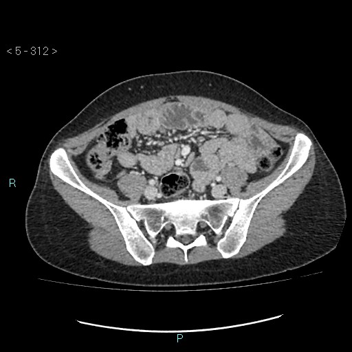 File:Adult transient intestinal intussusception (Radiopaedia 34853-36310 Axial C+ portal venous phase 74).jpg