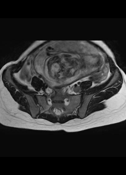 File:Aggressive angiomyxoma of the pelvis and perineum (Radiopaedia 59162-66479 Axial T2 22).jpg