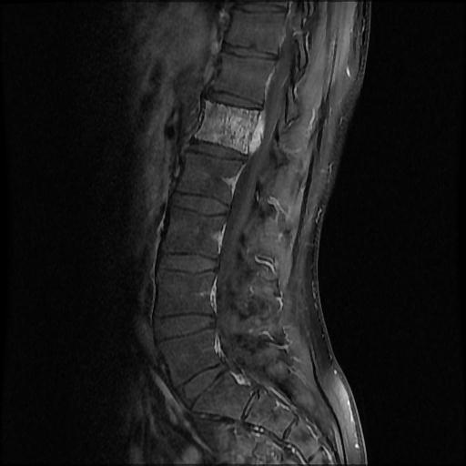 File:Aggressive vertebral hemangioma with pathological fracture (Radiopaedia 69528-79411 F 4).jpg