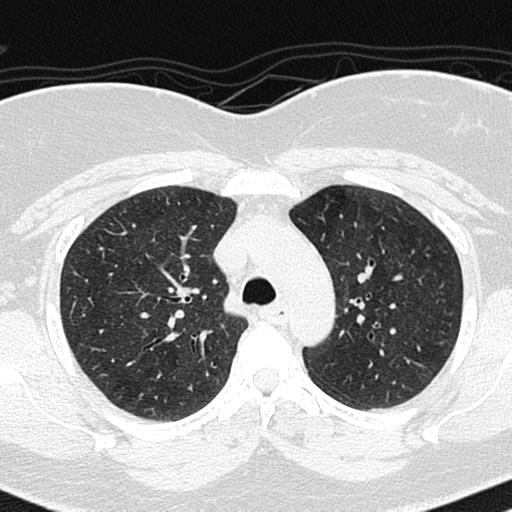 File:Air trapping in small airway disease (Radiopaedia 61685-69694 Axial lung window 48).jpg
