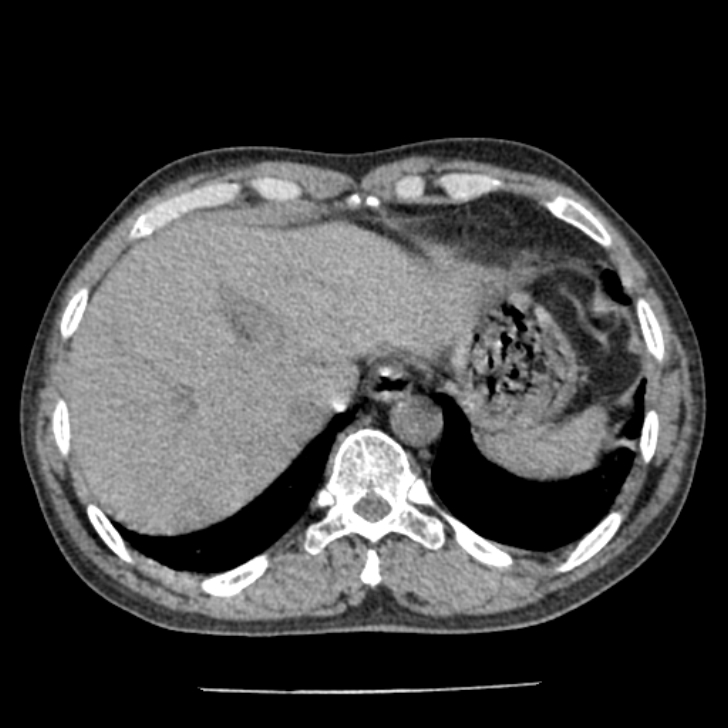 Airway foreign body in adult (Radiopaedia 85907-101779 Axial liver window 174).jpg