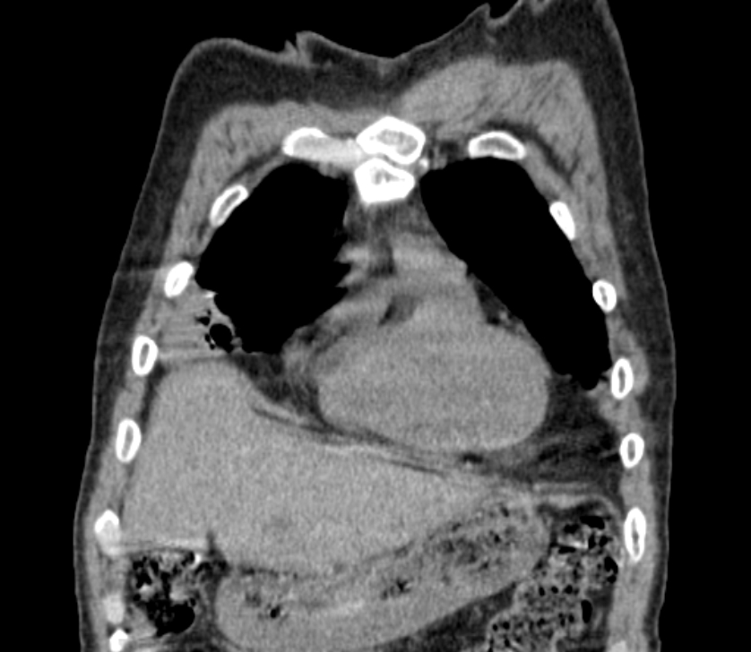 Airway foreign body in adult (Radiopaedia 85907-101779 Coronal liver window 44).jpg