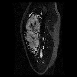 Alveolar soft part sarcoma (Radiopaedia 64501-73678 D 100).jpg