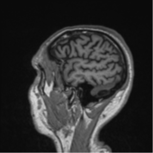Alzheimer's disease- with Gerstmann syndrome and dressing apraxia (Radiopaedia 54882-61150 Sagittal T1 9).png